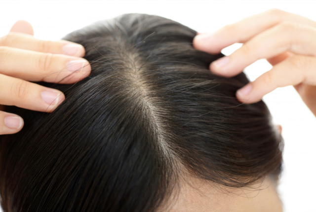 抜け毛が増えるのは頭皮のむくみが原因？